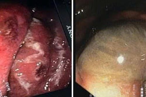 Bác sĩ sốc khi phát hiện dạ dày bệnh nhân gần như bị ăn mòn