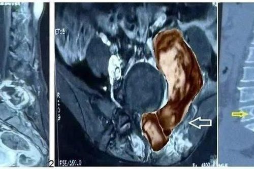 Người phụ nữ 48 tuổi tái phát khối u cột sống hiếm gặp
