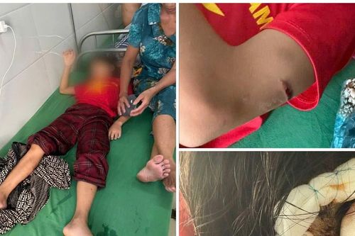 Trường học lên tiếng vụ học sinh lớp 5 nghi bị cha dượng bạo hành