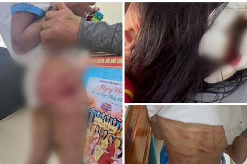 Nhiều cơ quan ở Hà Tĩnh lên án hành vi cha dượng bạo hành con riêng của vợ
