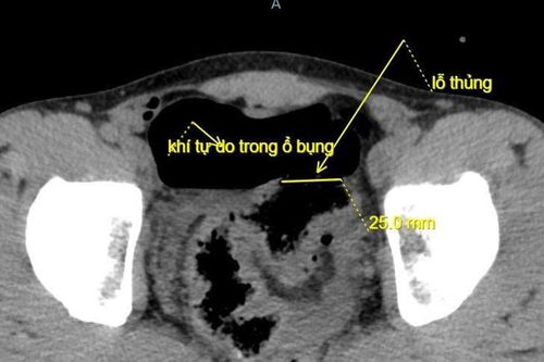 Hy hữu: Trêu đùa bằng vòi xịt rửa xe gây thủng đại tràng