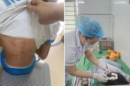 Cha dượng bạo hành bé gái lớp 5 ở Hà Tĩnh có thể đối diện với mức án nào?