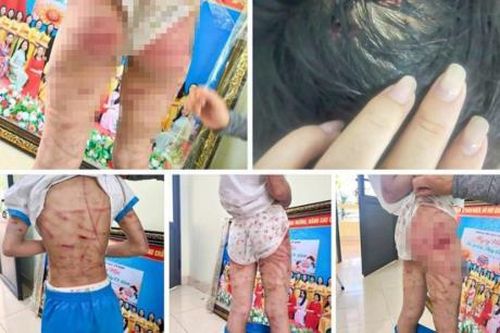 Bắt người cha dượng bạo hành con riêng của vợ để điều tra về hành vi 'Cố ý gây thương tích'
