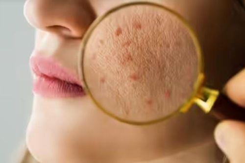 5 dấu hiệu mất cân bằng đường ruột thường biểu hiện trên da