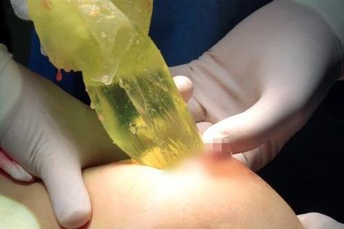 Người phụ nữ bị rò rỉ, vỡ túi ngực sau 14 năm nâng ngực: Túi ngực có thời hạn được bao lâu?