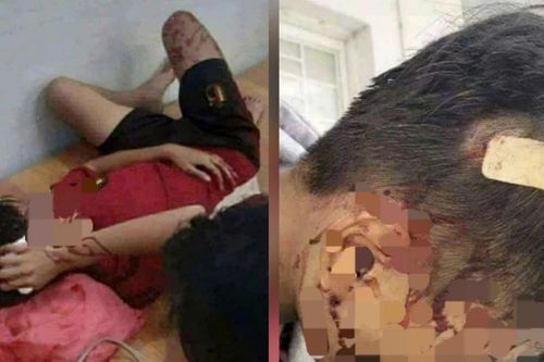 Mâu thuẫn cá nhân, học sinh lớp 8 bị bạn dùng gậy đánh nhập viện