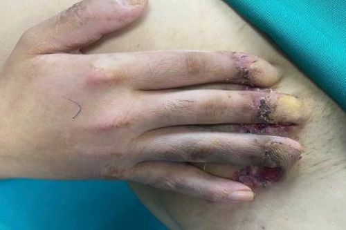 'Hồi sinh' bàn tay cho người đàn ông bị tai nạn lao động có nguy cơ phải tháo khớp ngón tay