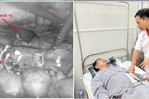 Người đàn ông 63 tuổi phải nhập viện cấp cứu vì ruột hoại tử do chủ quan với khối phồng vùng bẹn