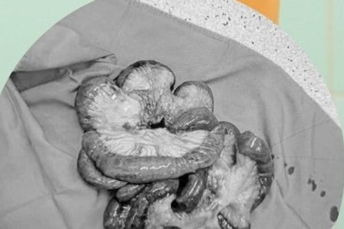 Phẫu thuật cắt 5 mét ruột non cứu bệnh nhân tắc động mạch hiếm gặp