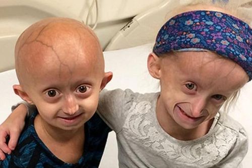 Trẻ nhỏ già đi như người già do bí ẩn gen lỗi trong hội chứng Progeria