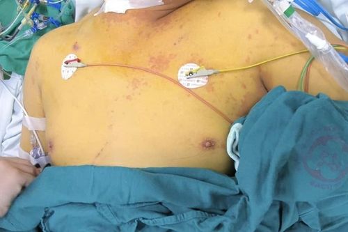 Da vàng như nghệ, suy gan thận vì vi khuẩn lan theo dòng nước