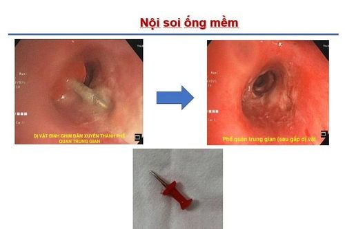 Bé 13 tuổi nguy hiểm tính mạng vì đinh ghim sắc nhọn rơi vào đường thở