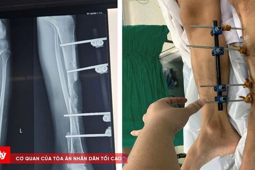 Kỳ tích tái tạo xương chày bằng vi phẫu cho bệnh nhân