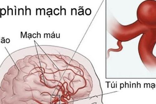 Người phụ nữ đi khám vì đau đầu bất ngờ phát hiện phình mạch máu não nguy hiểm