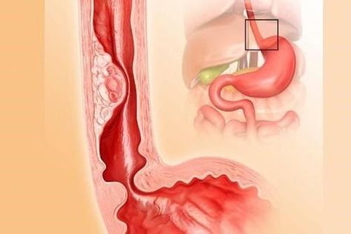 Ợ nóng, đau ngực cảnh báo viêm thực quản