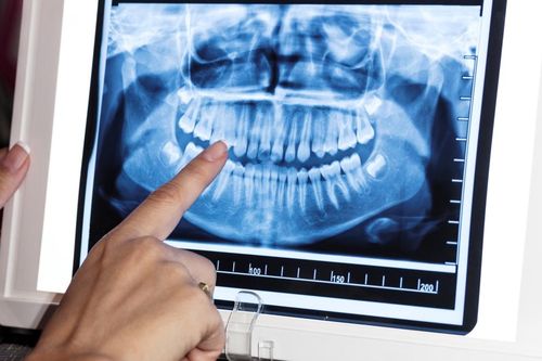 Bé 11 tuổi có 81 chiếc răng, bác sĩ lý giải nguyên nhân chuyện 'xưa nay hiếm'