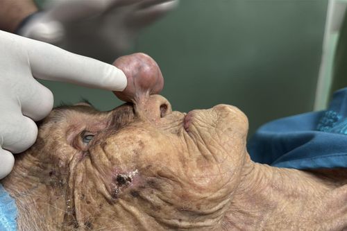 Ca mổ đặc biệt 'vì thương' giúp cụ bà gần 100 tuổi thoát khối u che lấp mũi, miệng
