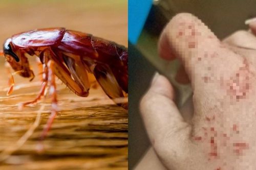 Điều gì xảy ra nếu chúng ta bị gián cắn?
