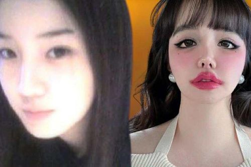 Tiếc cho gương mặt biến dạng của nữ ca sĩ hàng đầu showbiz