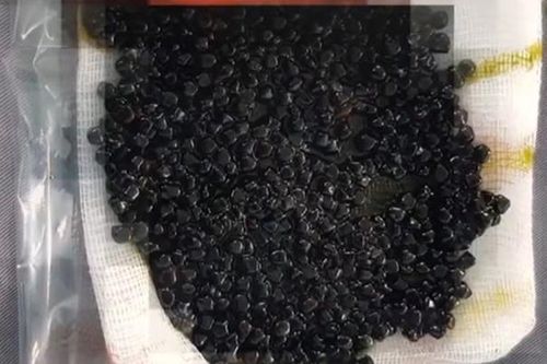 Hàng trăm viên sỏi ken đặc trong túi mật của người phụ nữ