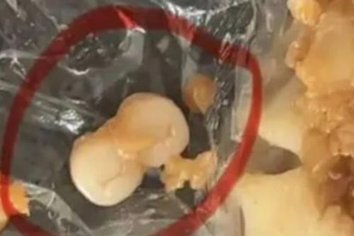 Liên tiếp phát hiện răng người trong đồ ăn tại Trung Quốc