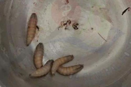 Gắp 5 con giòi sống làm tổ trong tai người phụ nữ