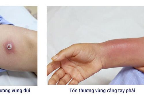 Tưởng giảm đau xương khớp, ai ngờ phải nhập viện vì nhiễm trùng nặng