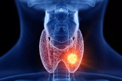 U nang tuyến giáp khi nào cần phẫu thuật? Cảnh giác với dấu hiệu u tuyến giáp ác tính
