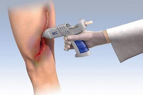Israel phát triển 'Keo thông minh' làm liền vết thương chỉ trong vòng 5 giây