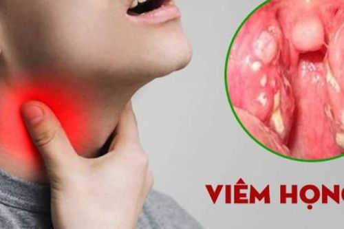 Thói quen giúp giảm triệu chứng viêm họng khi trời lạnh: Nên và không nên ăn gì để nhanh khỏi?