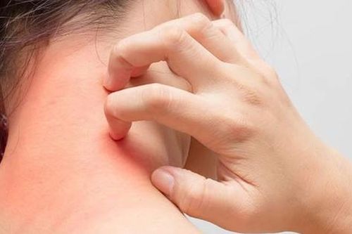 Mẹ bỉm cần cẩn trọng với mề đay sau sinh: Đừng chủ quan với những vết nổi ngứa