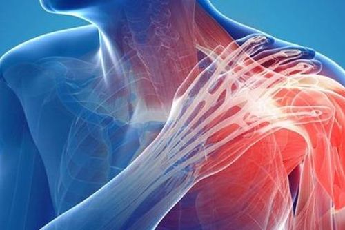 Viêm khớp vai: Cảnh giác với dấu hiệu nhiều người Việt bỏ qua