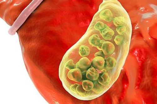 Đau bụng kéo dài cảnh giác với sỏi túi mật