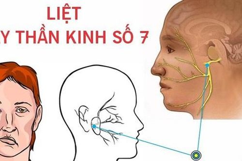 Thanh niên 23 tuổi ở Hà Nội méo miệng, liệt dây thần kinh số 7 thừa nhận mắc sai lầm này khi tắm đêm