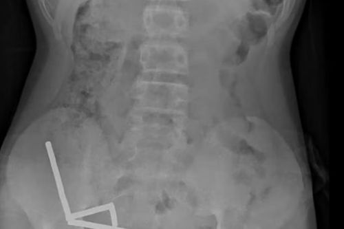 Bé trai phải cắt ruột sau khi nuốt 100 viên nam châm