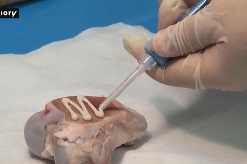 Trung Quốc phát minh keo gắn xương đầu tiên trên thế giới