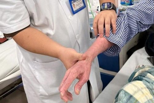 Loại bỏ bệnh da di truyền hiếm gặp nhờ phương pháp điều trị mới