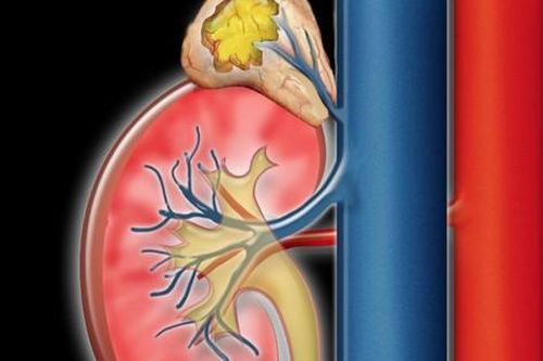 Thanh niên 16 tuổi bị tăng huyết áp kéo dài, bác sĩ tìm ra nguyên nhân bất ngờ