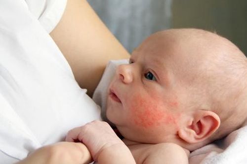 Trẻ em hay mắc các bệnh dị ứng nào?