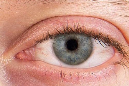 Khô mắt do rối loạn hệ miễn dịch