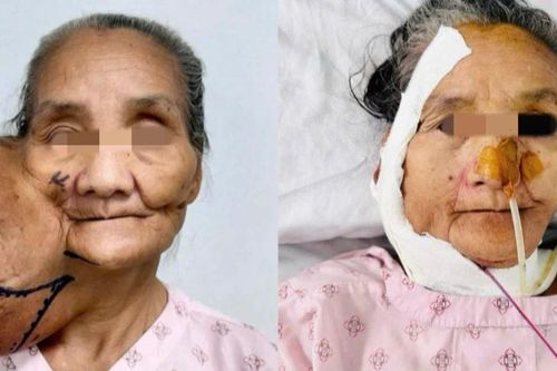 Diện mạo mới của người phụ nữ dân tộc thiểu số sau 40 năm mang khối u khổng lồ