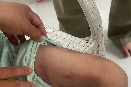 Khởi tố vụ bé gái bị mẹ ruột và người tình bạo hành