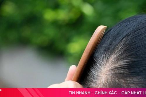 Thực phẩm quen thuộc gây bạc tóc, hói đầu sớm