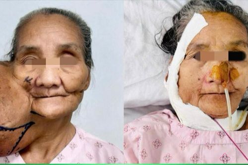 Ca phẫu thuật nhân đạo giúp người phụ nữ thoát khối u đeo bám suốt 4 thập kỷ