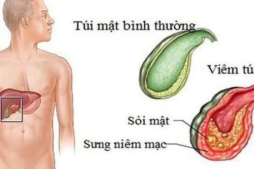 Dấu hiệu của viêm túi mật theo từng giai đoạn