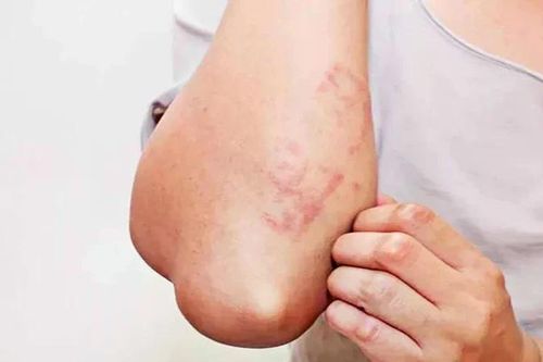 Nhiễm giun sán có thể gây ra nhiều vấn đề sức khỏe nghiêm trọng