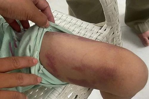 Vụ bé gái 9 tuổi bị bạo hành: Bắt tạm giam mẹ ruột và người tình