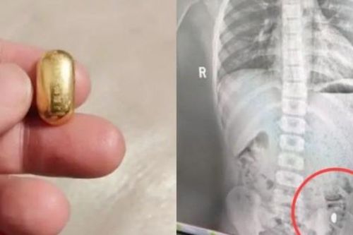 Cậu bé 11 tuổi nuốt nhầm hạt vàng trị giá 36 triệu đồng và cái kết