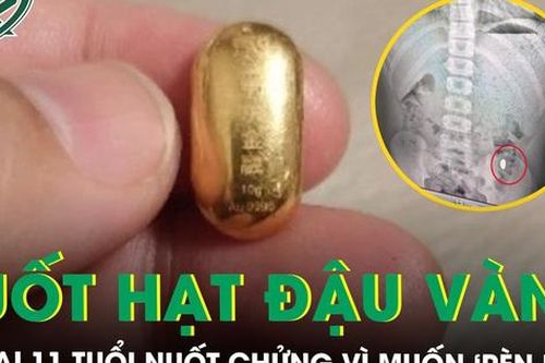 Bé trai 11 tuổi cấp cứu sau khi nuốt hạt đậu vàng 10 gram để 'rèn lưỡi'