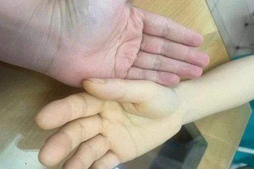 Mất lượng 3/4 lượng máu trong cơ thể vì chủ quan không loại bỏ u xơ tử cung